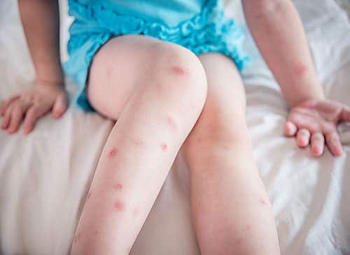 Bed Bugs Bites Pictures
